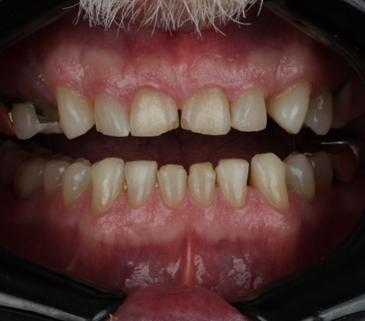 Antes y después diseño de sonrisa Cali — caso 1, antes