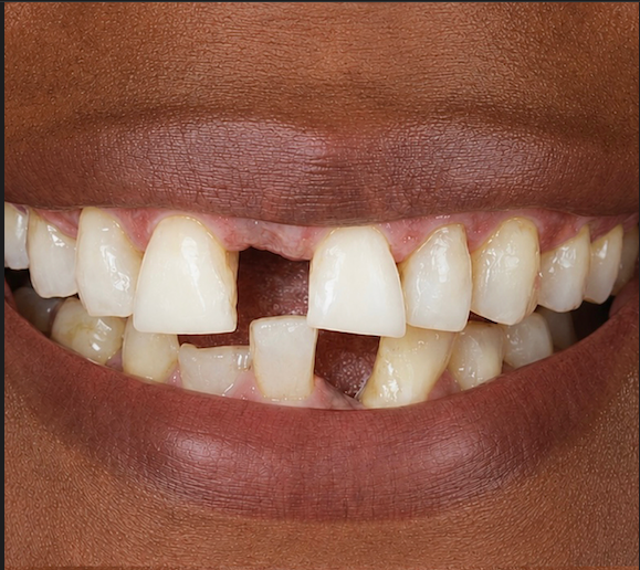 Antes y después diseño de sonrisa Cali — caso 3, antes