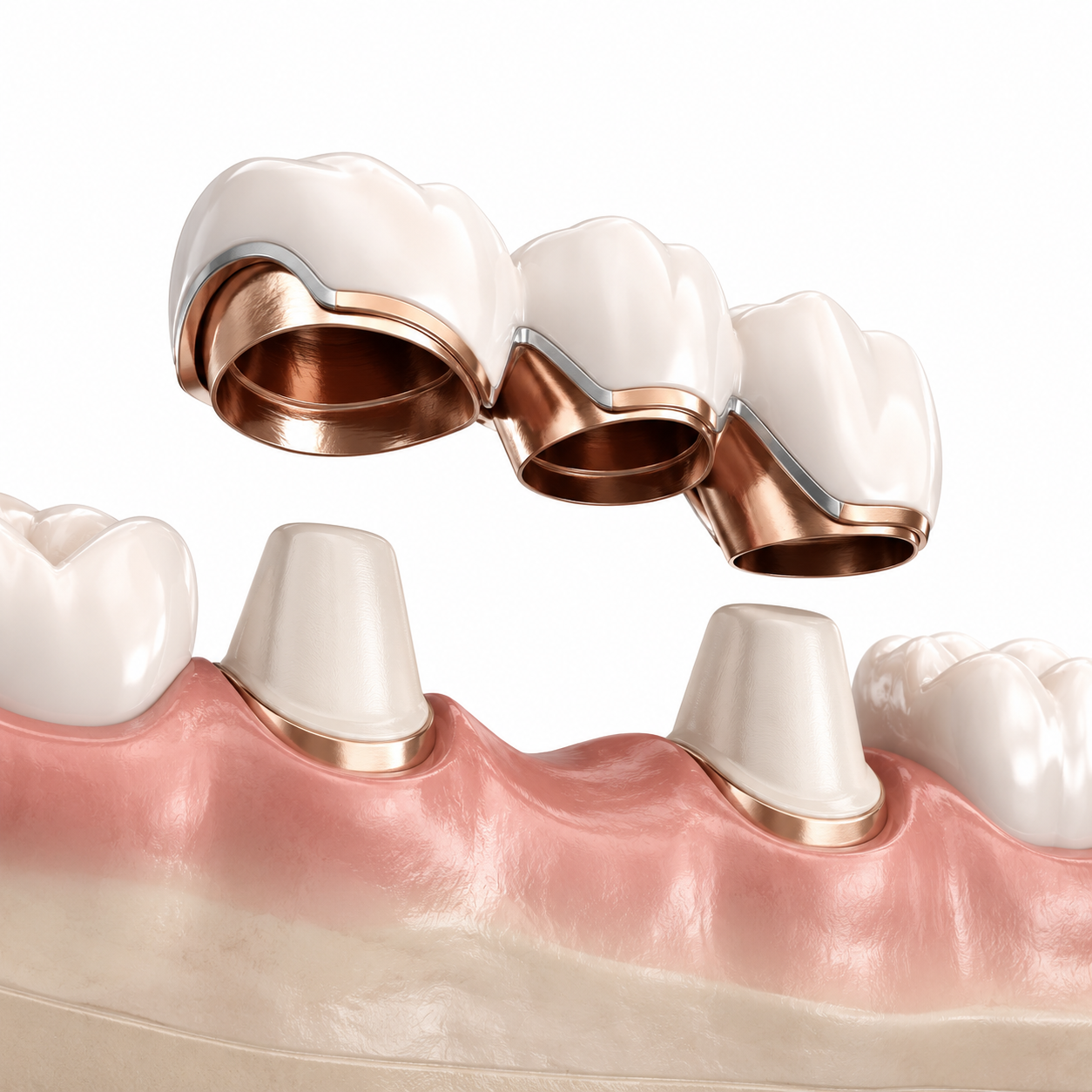 Rehabilitación oral en Cali — puente e implante dental