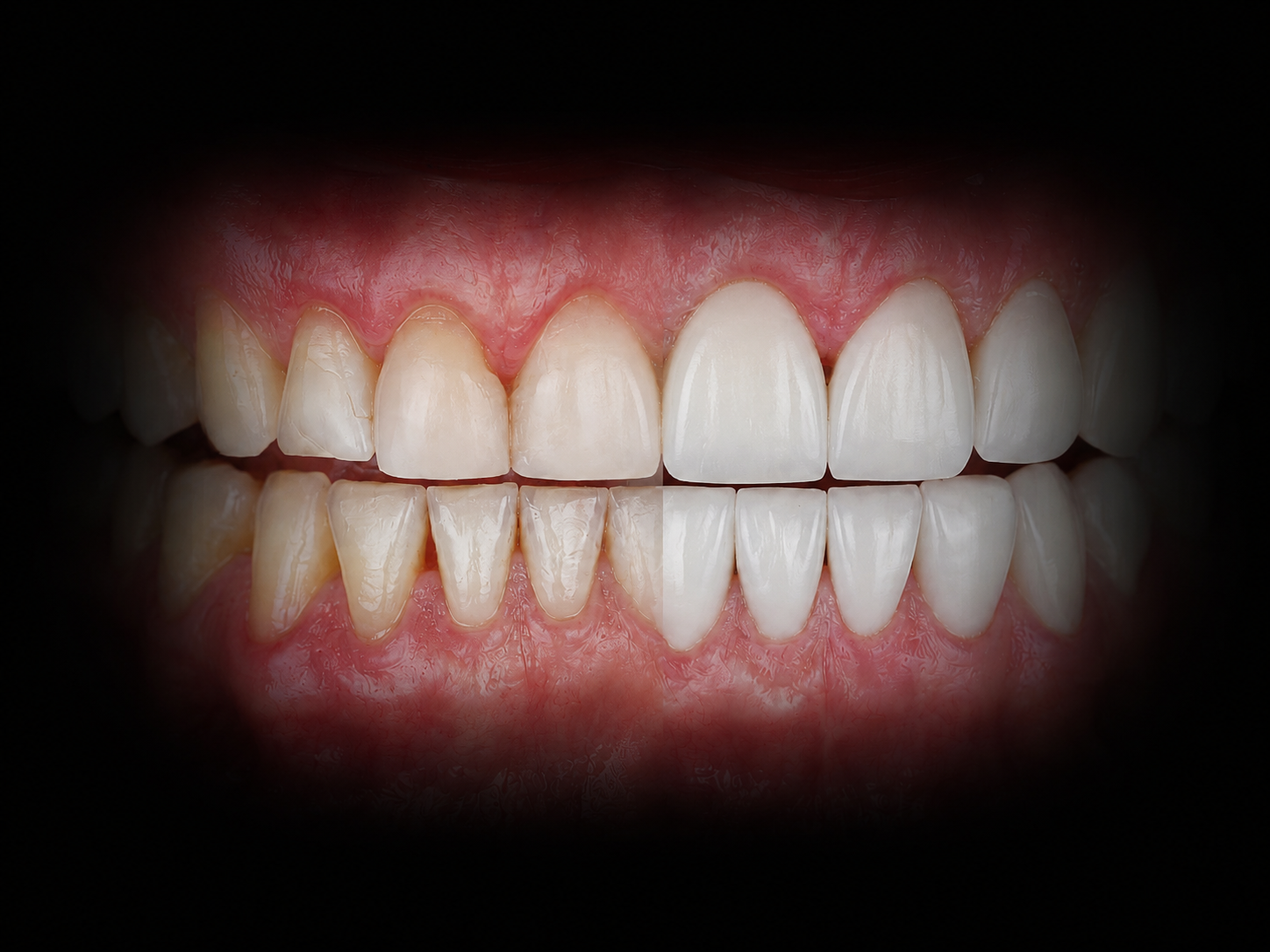 Antes y después del diseño de sonrisa